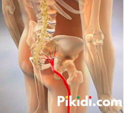 Effective therapy for sciatica