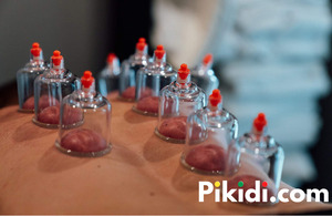 Cupping Therapy for improved blood circulation