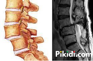 Cervical Spondylosis Treatment in Lagos